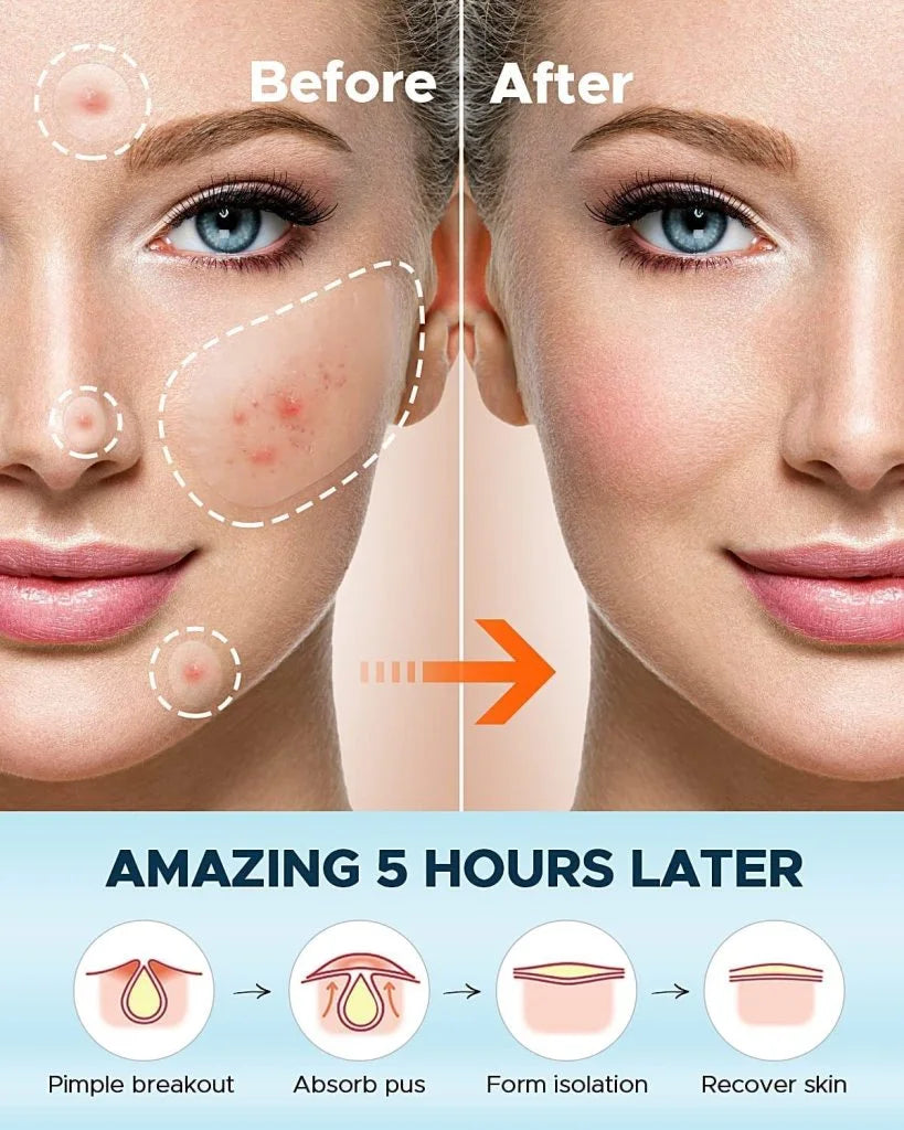 36 pcs Acne Patch Pimple Patch